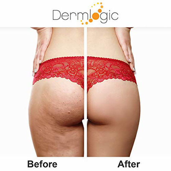 Picture of GetUSCart- Anti-Acne Thigh & Buttocks Treatment - Clears Away Acne ...