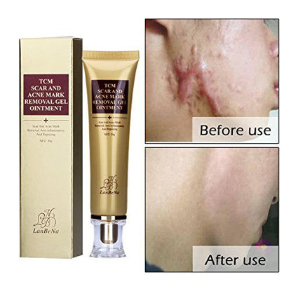 Picture of Acne Scar Removal Cream Stretch Marks Face Skin Repair Cream Shrink Pores Gel-Fade Scar Marks Acne Skin Care (30ml)