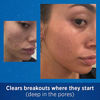 Picture of Acne Treatment Differin Gel, Acne Spot Treatment for Face with Adapalene (Up to 90 Day Supply), 45 Gram, Pump