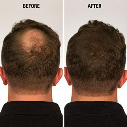 Picture of Infinity Hair Fiber - Hair Loss Concealer - Hair Thickening Fiber for Men & Women - Medium Brown, 28g