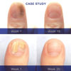 Picture of Extra Strength Toenail Fungus Treatment For Toenail Or Fingernail, Nail Repair Solution, Nail Renewal Liquid For Damaged & Discoloration Nail(1oz)