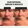 Picture of 𝐖𝐈𝐍𝐍𝐄𝐑 𝟐𝟎𝟐𝟑 Retinol Serum for Face - 2.5% Pure Retinol Anti Wrinkle Serum with Hyaluronic Acid + Vitamin B3, Resurfacing Retinol Serum for Face Anti Aging Skin, for Men & Women, Facial Acne Retinol Serum
