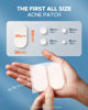 Picture of LitBear Acne Pimple Patches, 5 Sizes 80 Patches for Large Zit Breakouts, Face, Chin or Body, Spot Treatment with Tea Tree & Calendula Oil, Hydrocolloid Bandages Skin