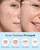 Picture of LitBear Acne Pimple Patches- Day and Night 6 Sizes 204 Dots Thin & Thick Hydrocolloid Patches with Witch Hazel, Tea Tree & Calendula Oil, Extra Adhesion for Face Zit Patch Dots