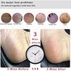 Picture of Kinepi Foot File Callus Remover Foot Scrubber,Professional Pedicure Foot Rasp Removes Cracked Heels,Dead Skin,Corn,Hard Skin,Pumice Stone for Scraper File Brush Tools for Wet and Dry Feet