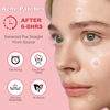 Picture of 72 Counts Pimple Patches for Face Hydrocolloid Acne Patches for face Invisible Zit Patches for Face Pimple Patch Acne Spot Patch Blemish Patches Cover Patches Stickers