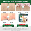 Picture of Silicone Scar Sheets,Silicone Scar Tape,Silicone Sheets For Scars,Scar Tape For Surgical Scars,Keloid Bump Removal,Scar Removal For Surgical(1.6"x 120" Roll-3M)