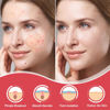 Picture of 432 Counts Pimple Patches for Face, Hydrocolloid Acne Patches Zit Patches for Face Acne Spot Treatment Patch Cystic Acne Treatment Stickers Blemish Hydrocolloid Patches for all Skin Type
