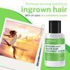Picture of LAVO Tea Tree Gel w/Salicylic Acid - BEST Ingrown Hair Treatment - Razor Bump and Burn Remover - Bikini Lines & Acne - Use After Shaving, Hair Removal, Waxing, Laser, Electrolysis - for Men and Women