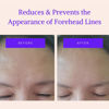 Picture of Blumbody Forehead Wrinkle Patches - Anti Wrinkle Facial Patches to Smooth Eyes & Forehead Wrinkles - Non-Silicone Face Tape for Fine Wrinkles between Eyes & Face - 50 Patches (Up to 60 day supply)