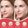 Picture of 216 Counts Pimple Patches for Face, Hydrocolloid Acne Patches Zit Patches for Face Acne Spot Treatment Patch Cystic Acne Treatment Stickers Blemish Hydrocolloid Patches for all Skin Type