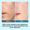 Picture of Elvira Korean Skincare Anti-Aging & Glycolic Acid Exfoliating Facial Pads With 10% Glycolic Acid, 2% Salicylic Acid & Niacinamide - 60 Toner Pads, Daily Peel Treatment for Acne Prone Sensitive Skin
