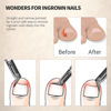 Picture of FERYES Toenail Clipper Straight Blade for Ingrown and Thick Nails - Stainless Steel and Sharp Pointed Tip Ingrown Nail Clipper - Wide Jaw Toe Nail Cutter Ingrown Tool