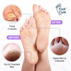 Picture of Lavender Foot Soak & Callus Remover Gel Kit - Extra Strength Callus Remover Gel for Feet, Remove Calluses with Epsom Salts, Dry Cracked Heels & Foot Odor, at Home Pedicure - Foot Care for Tired Feet