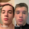 Picture of Shield System, Acne System for Men, Face Wash, Moisturizer, Pimple Patches, Shield Men's Skin Care Set (4 Months)